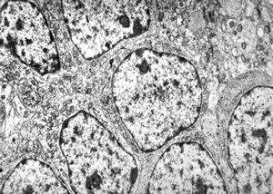 M,1y. | neuroblastoma - retroperitoneum M,1y. | neuroblastoma - retroperitoneum